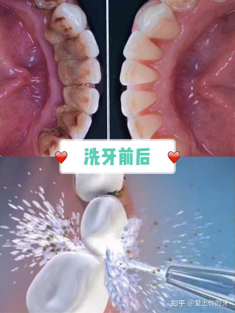 广元洗牙可以用医保吗(洗牙可以用医保吗,报销比例多少)